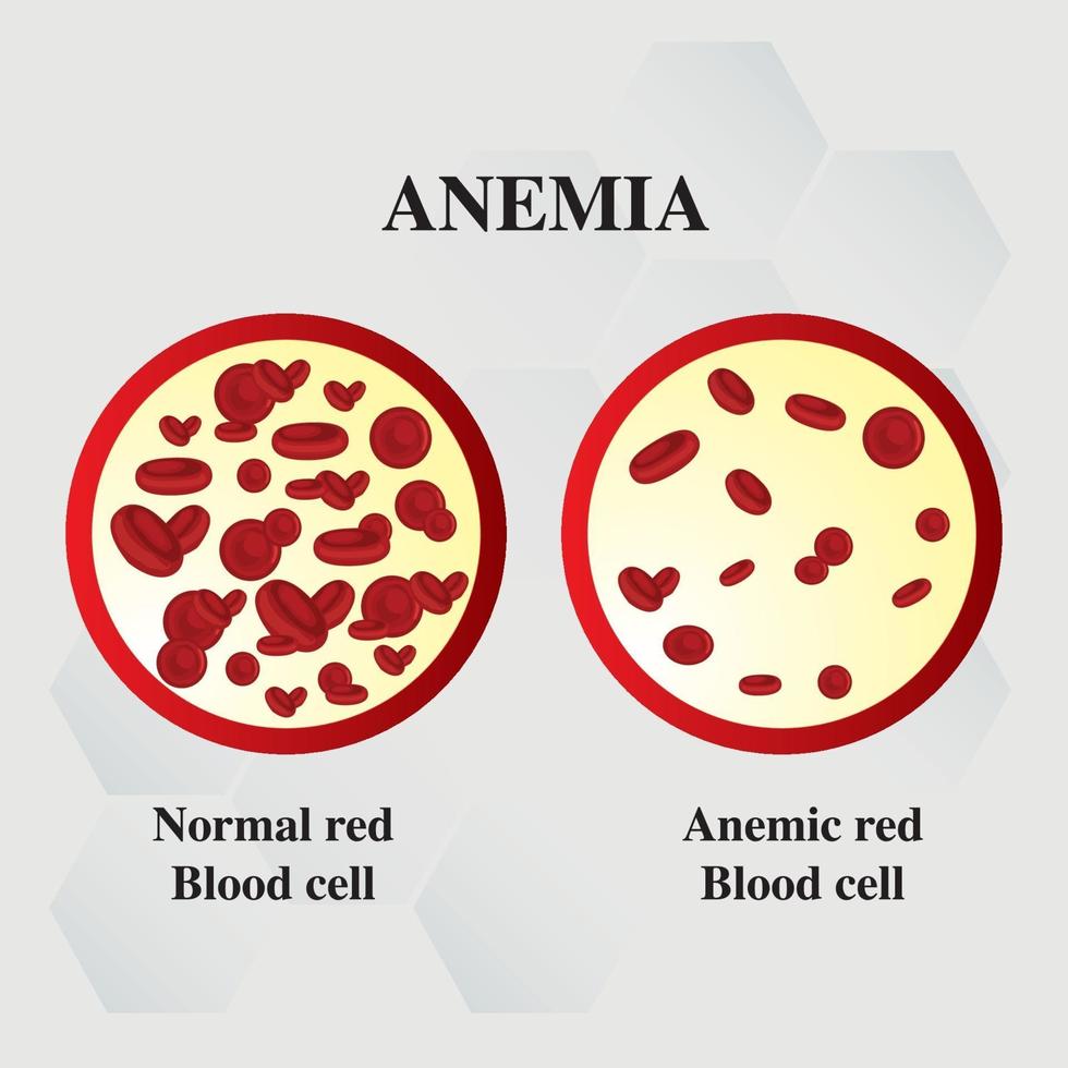 anemia-amount-of-red-blood-iron-deficiency-anemia-difference-of-anemia-amount-of-red-blood-cell-and-normal-symptoms-illustration-medical-vector